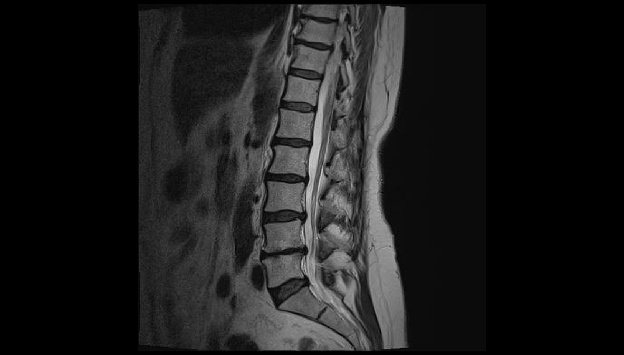 Diagnose von Rückenschmerzen im Lendenbereich