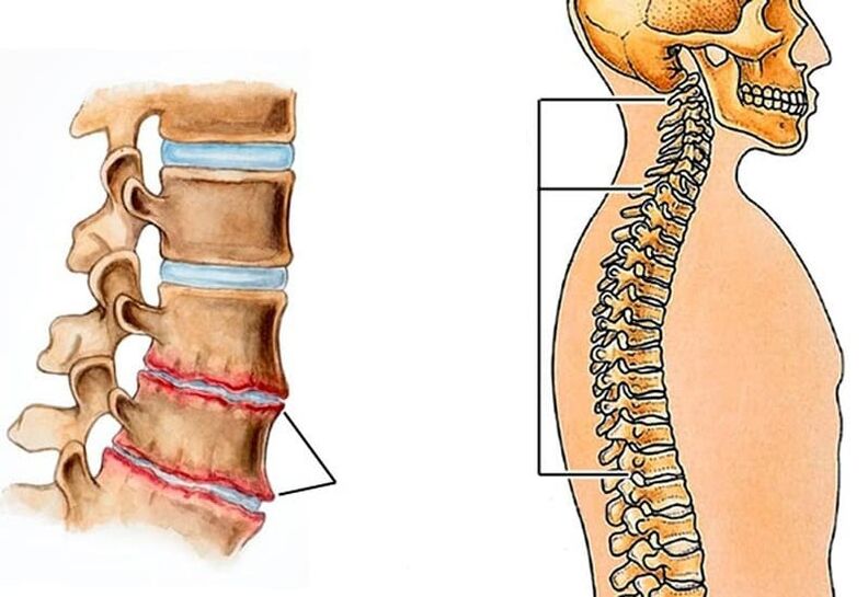 Krümmung der Wirbelsäule verursacht Rückenschmerzen