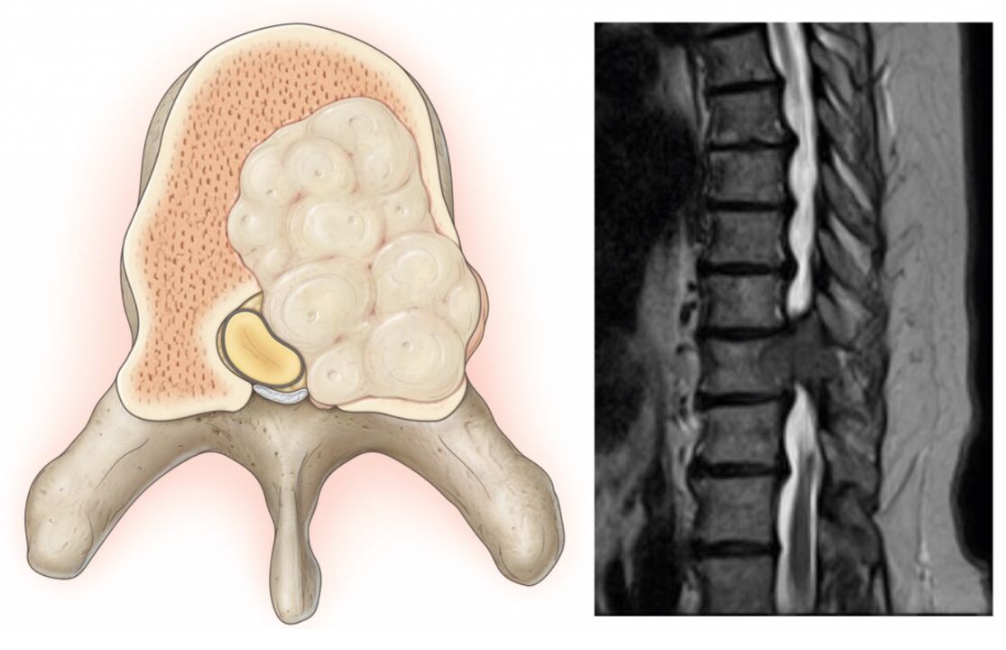 Schwellung der Wirbelsäule verursacht Rückenschmerzen