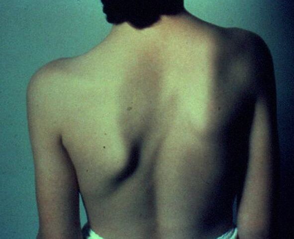 Morbus Sprengel als Ursache für Schmerzen unter dem linken Schulterblatt