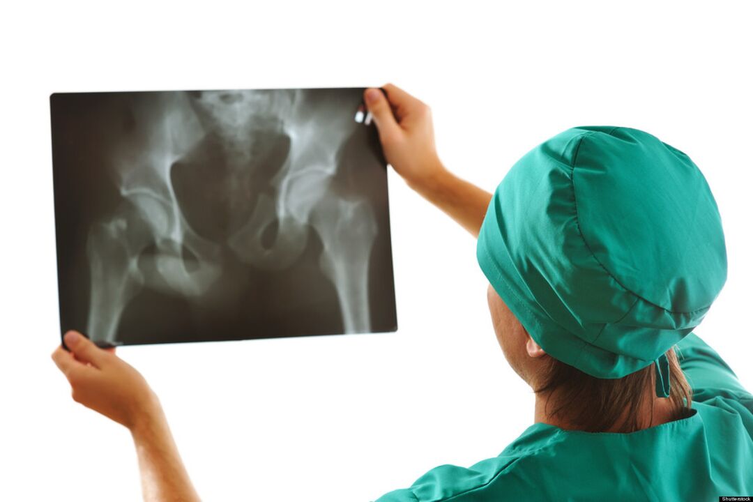 Röntgenbild des Hüftgelenks mit Arthrose. 