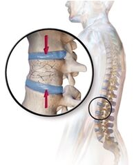 Osteoporose verursacht Rückenschmerzen im unteren Rücken. 