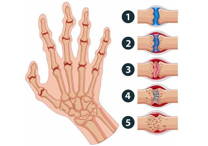 Entwicklungsstadien der Arthritis der Fingergelenke. 