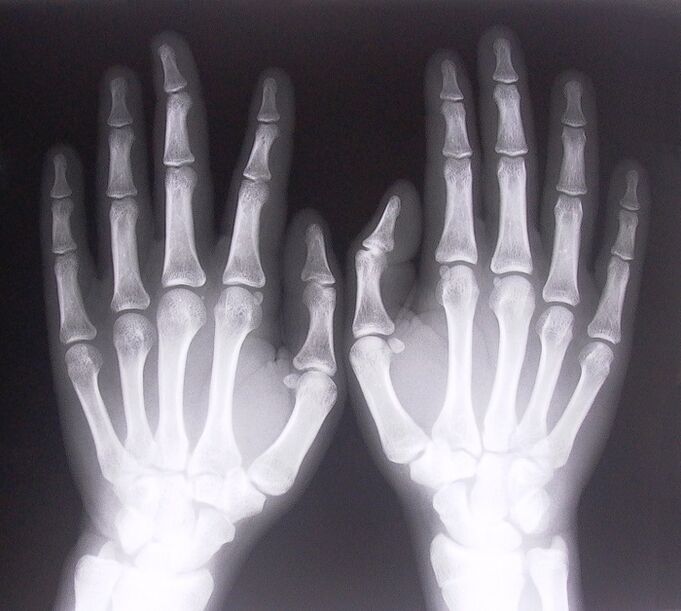 Röntgen als eine Möglichkeit, Schmerzen in den Fingergelenken zu diagnostizieren. 
